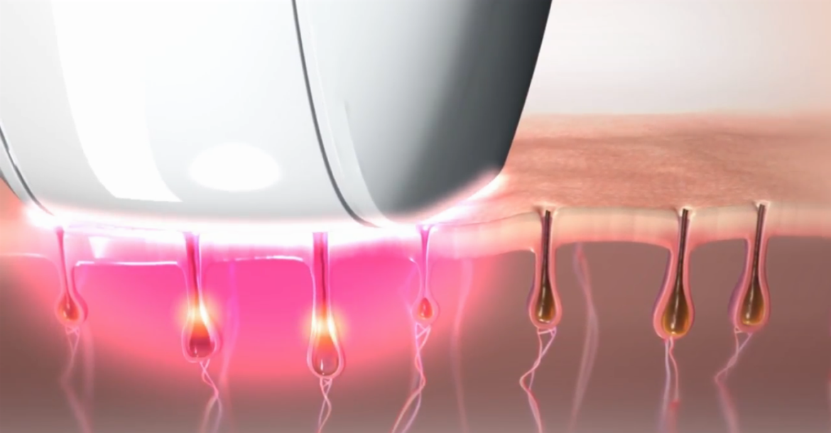 جهاز بيور لإزالة الشعر بتقنية الومضات الضوئية